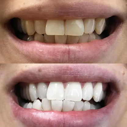 ShinySmile™ — Instantly Whiten & Boost Confidence | 1+1 FREE